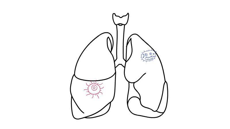 肺炎简笔画 肺炎简笔画步骤