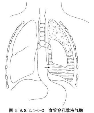 食管简笔画